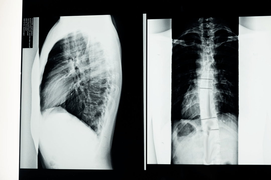 artroza pregleda lumbosakralne kralježnice bolovi u zglobovima i vratu