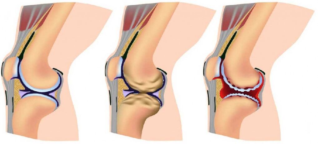 liječenje zglobova koljena s artrozom