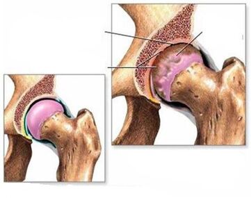 osteoartritis zgloba