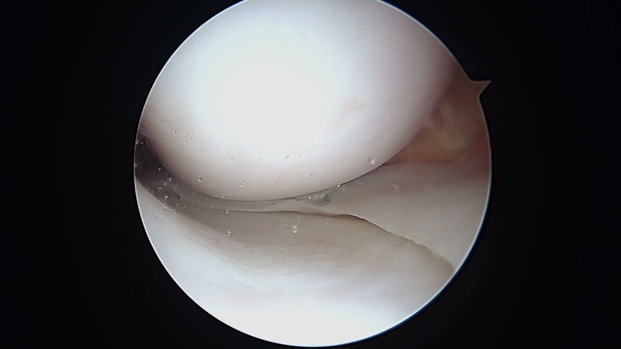 pogled na zglob koljena kroz artroskop