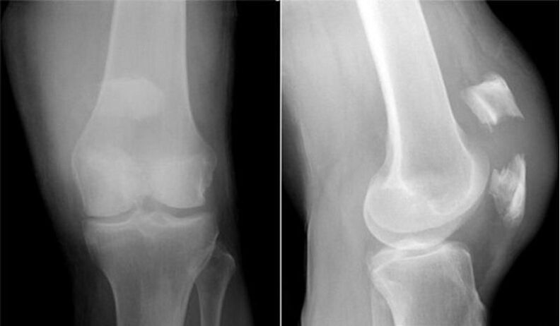 rendgenski snimak koljena