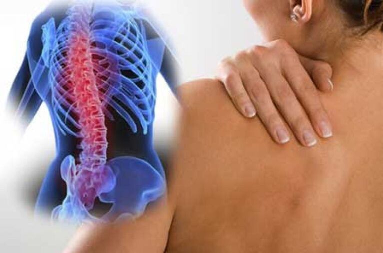 Kod osteohondroze bol može zračiti u udaljene dijelove tijela