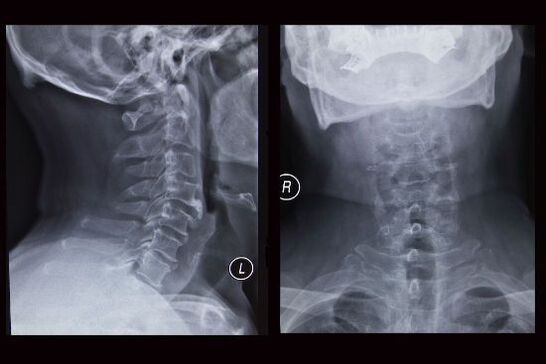 Rentgenska slika vratne kralježnice (pacijent ima osteohondrozu)