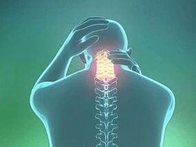 Simptom cervikalne osteohondroze je glavobolja