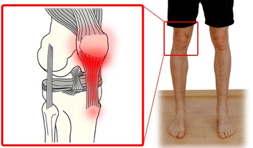 Tendinitis je upala tkiva tetive koja uzrokuje bol u zglobu koljena. 