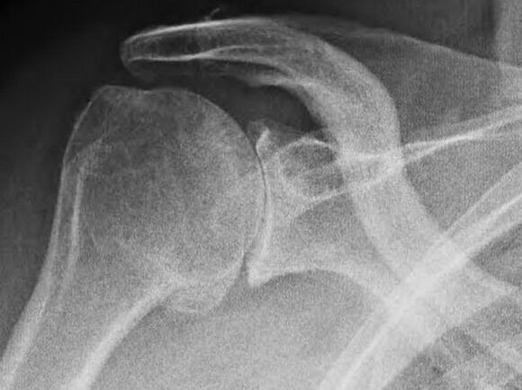 RTG snimka ramenog zgloba zahvaćenog artrozom