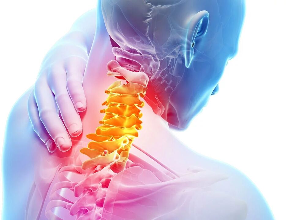 Cervikalna osteohondroza