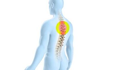 osteohondroza torakalne kralježnice
