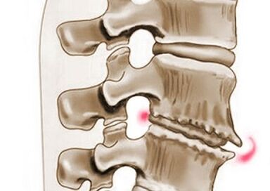 oštećenje kralježaka u torakalnoj osteohondrozi