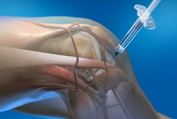 intraartikularne injekcije za artrozu zgloba koljena
